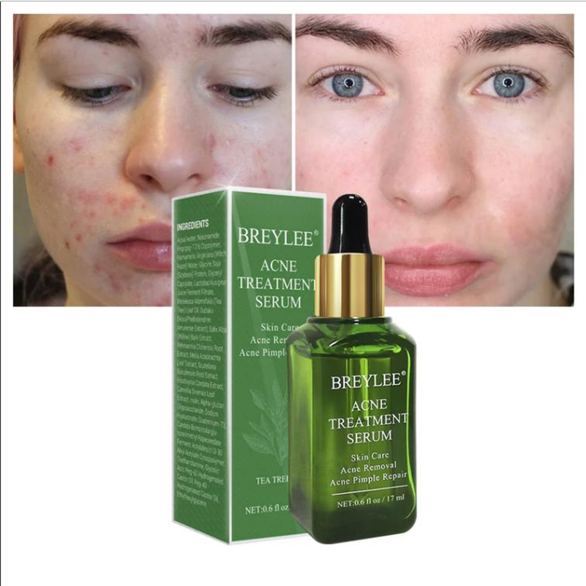 Acne Treatment Serum - 3